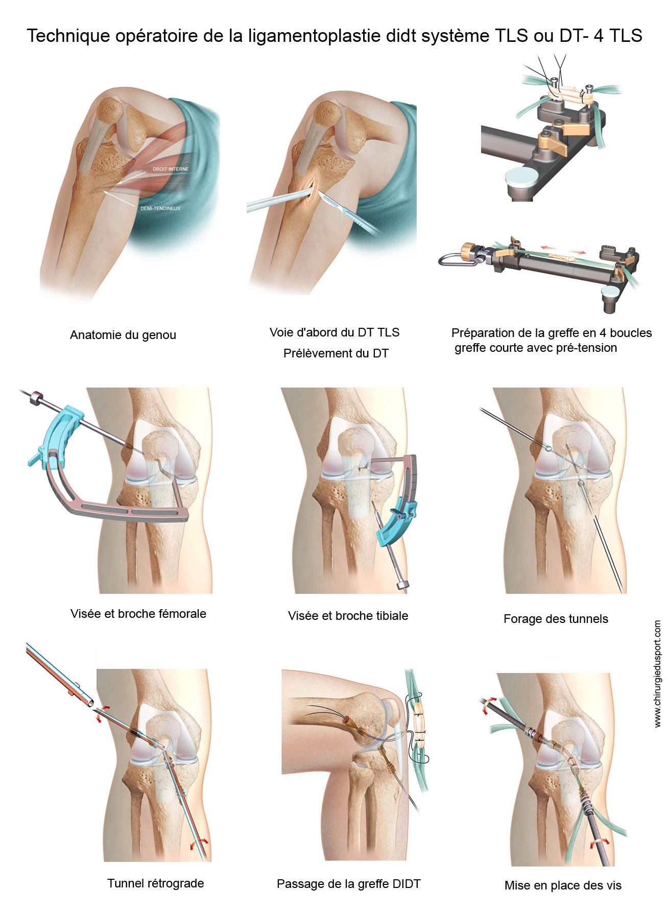 fiche ligament didt systeme TLS ou DT4 TLS