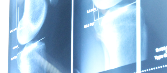 Radiologie 3D femur